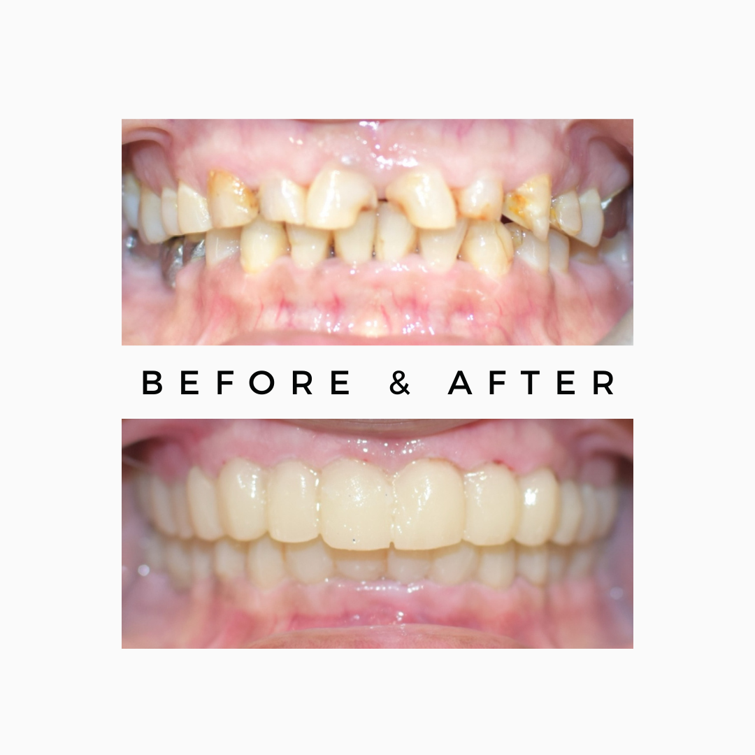 Root Canal Treatment