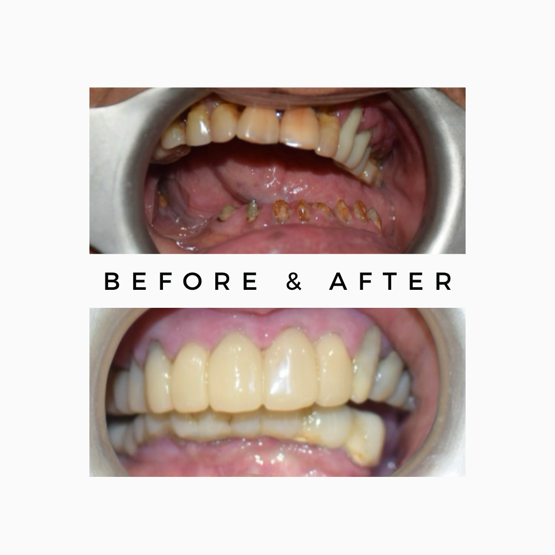 Oral Cancer Rehabilitation