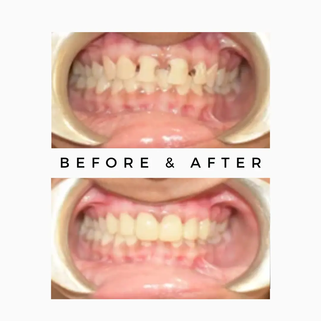 Brittle Teeth Correction - Smile Makeover
