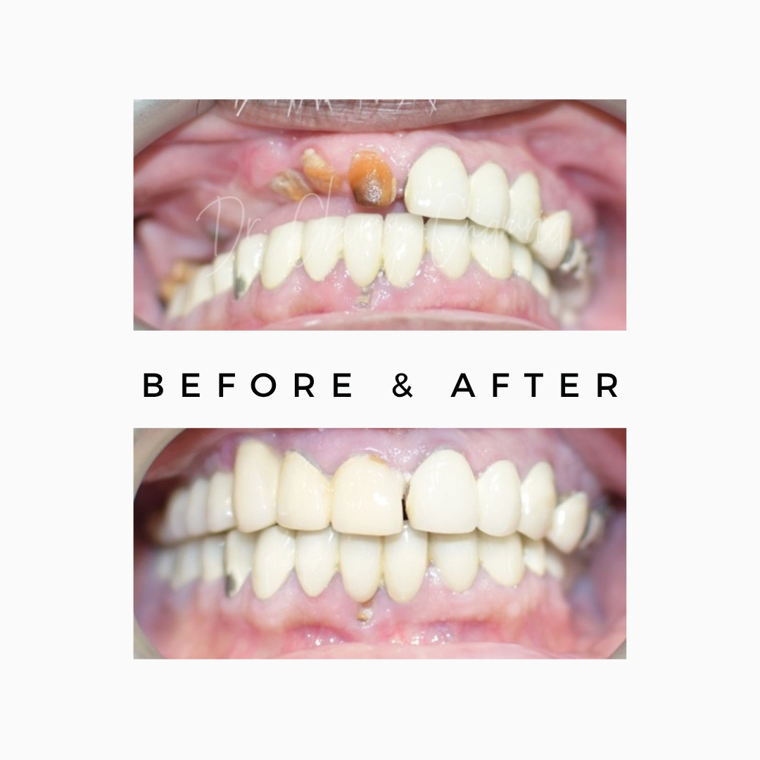 Root Canal Treatment in Mumbai