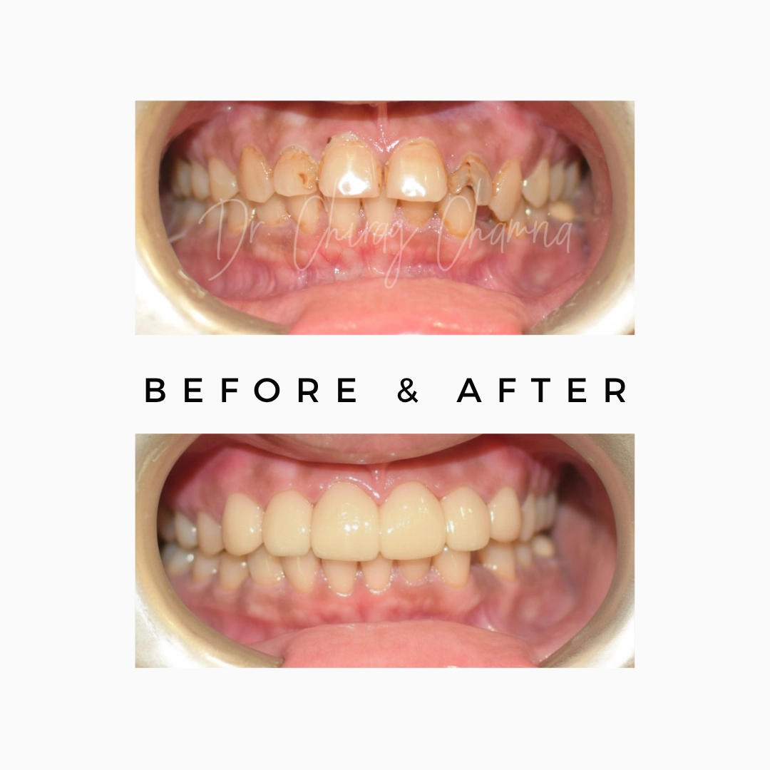 Cosmetic Dentistry and Smile Makeover