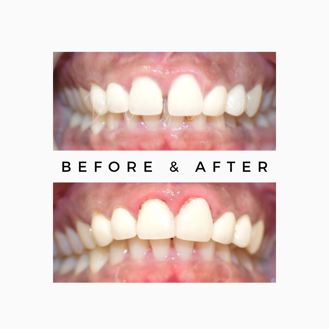 Cosmetic Dentistry and Smile Makeover