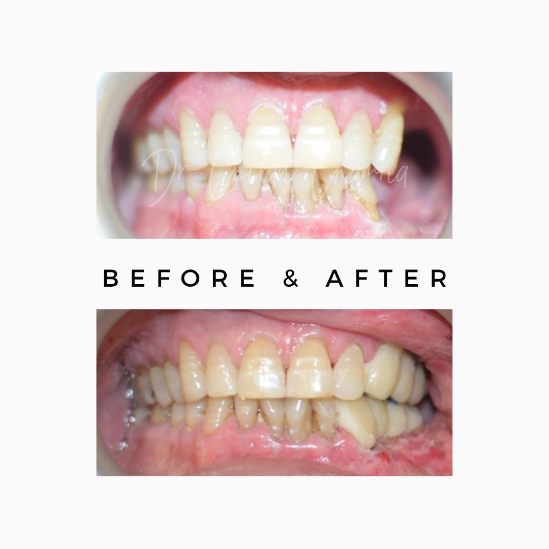 Dental Rehabilitation Treatment After Oral Cancer
