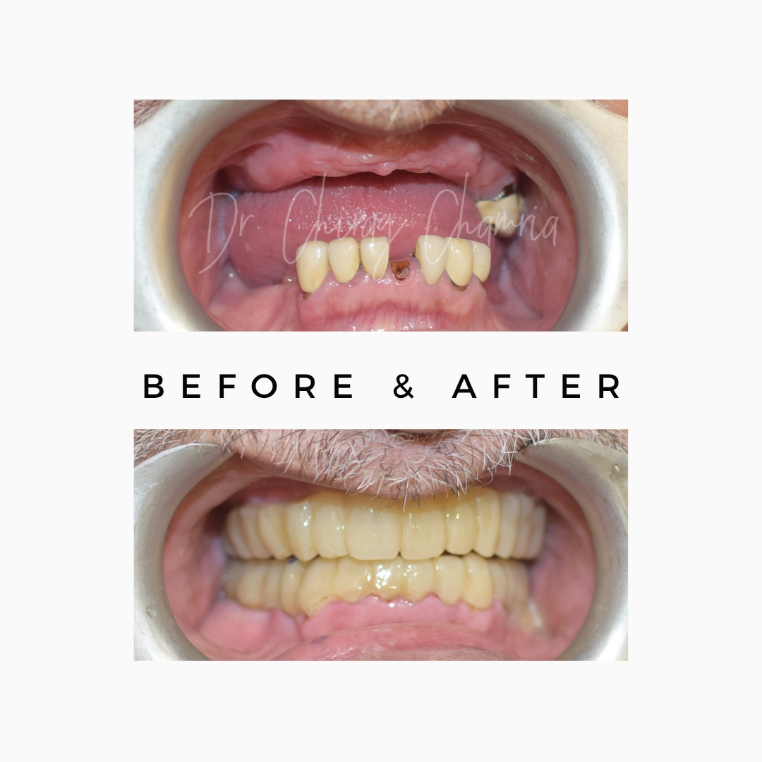 Full Mouth Dental Implants for Fixed Teeth