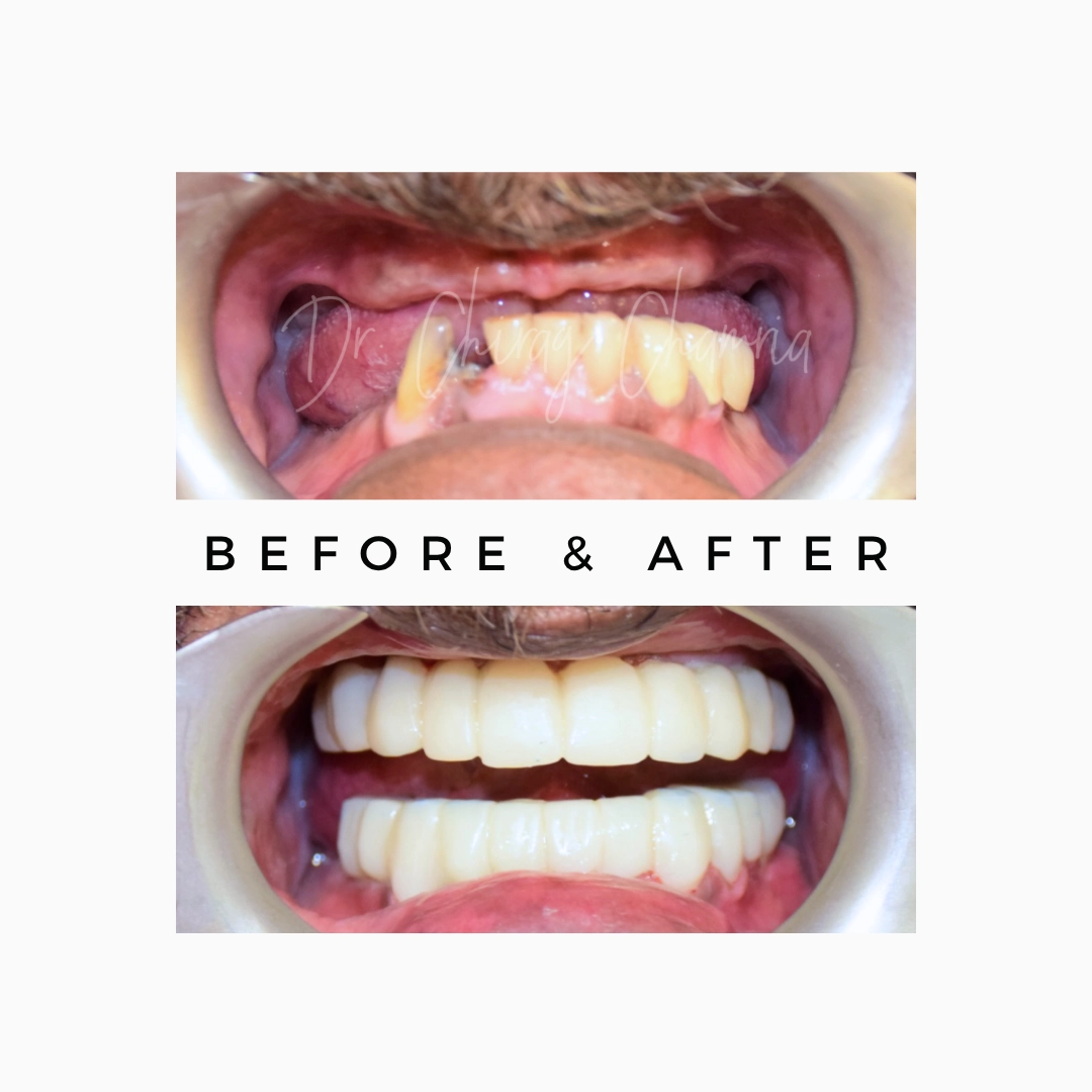 Full-mouth Dental Implants