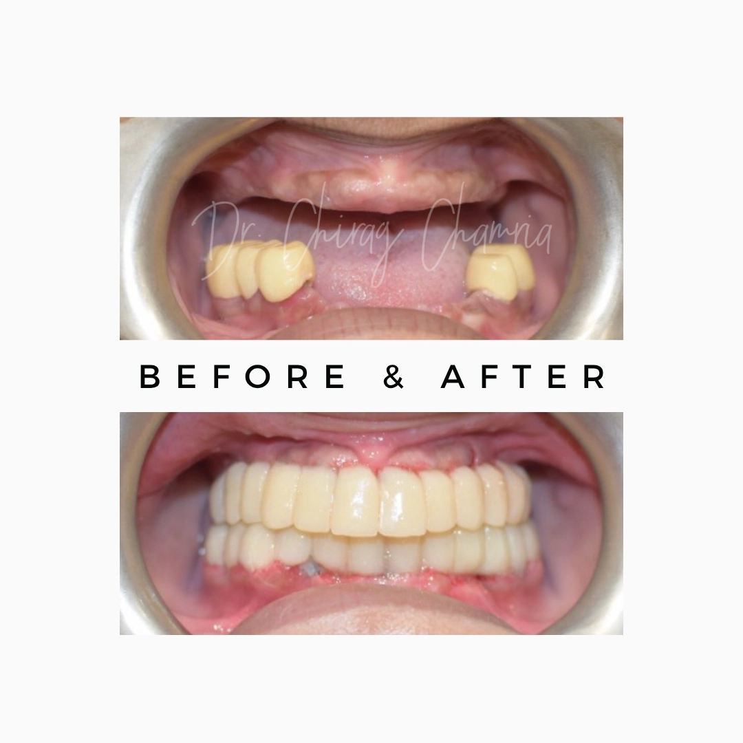 Multiple Missing Teeth Replacement