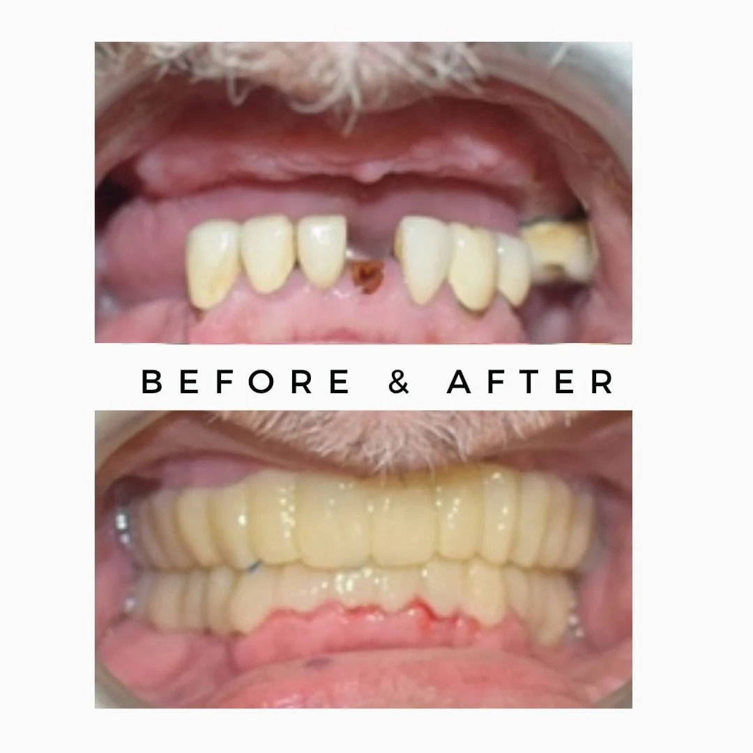 Same-Day Full Mouth Rehabilitation