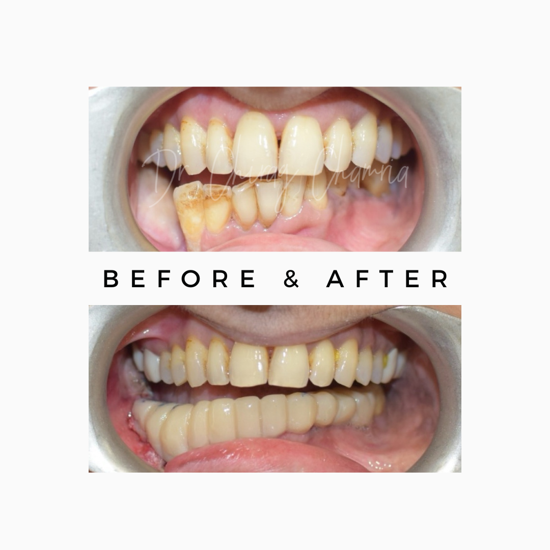 Lower Teeth After Oral Cancer Surgery