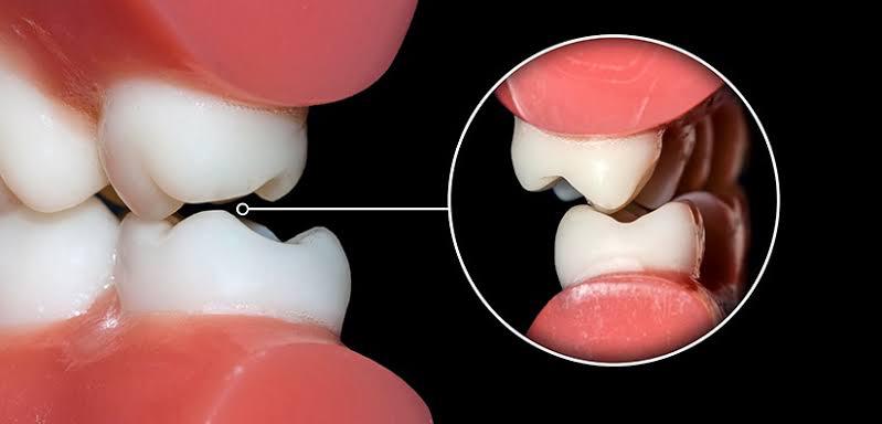 Bite Alignment