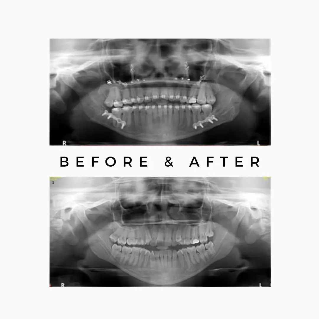 Orthognathic Jaw Surgery in Mumbai