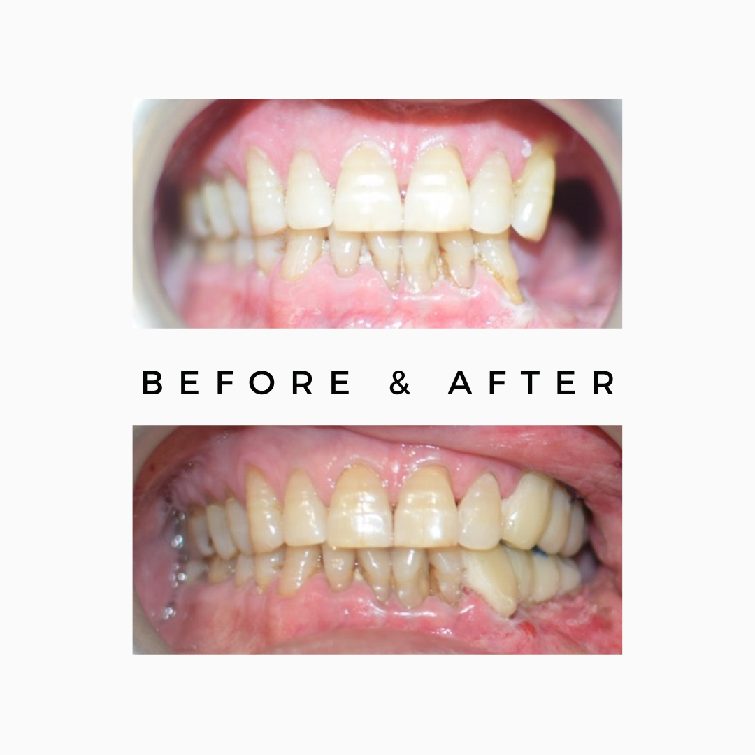 Upper Posterior Teeth After Cancer