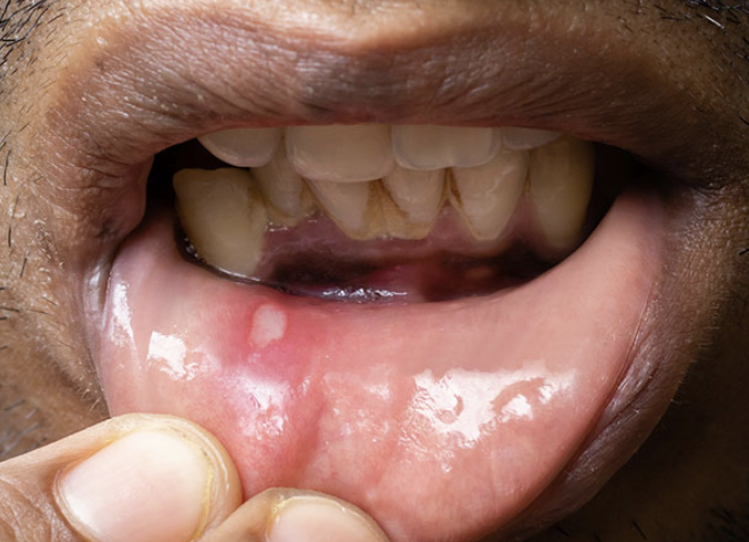 Oral Ulcer Treatment in Mumbai