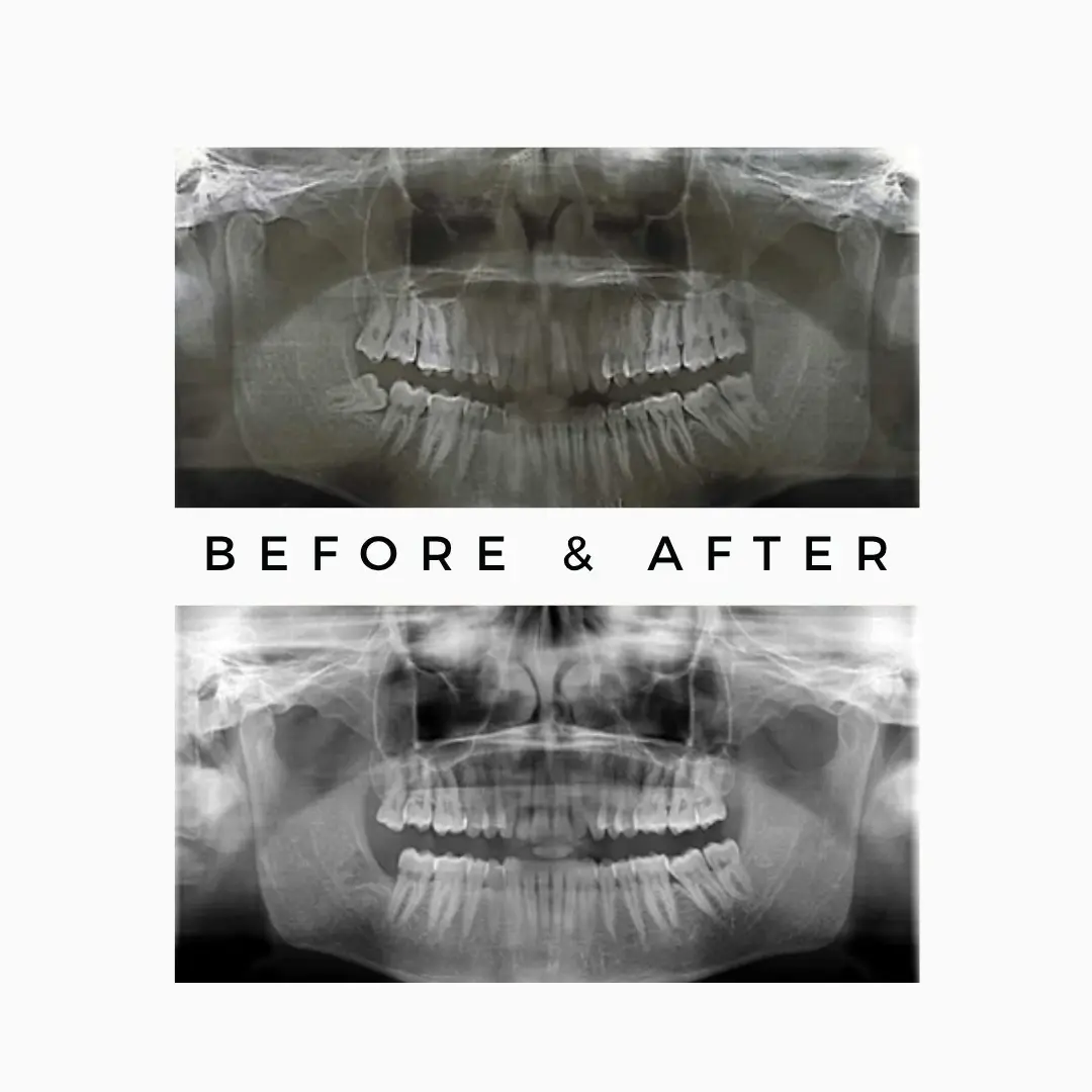 Wisdom Tooth Extraction