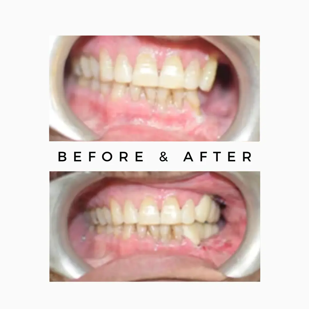 Teeth After Cancer