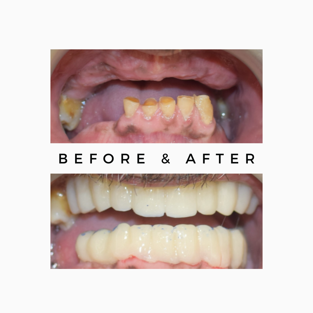 Dental Implants