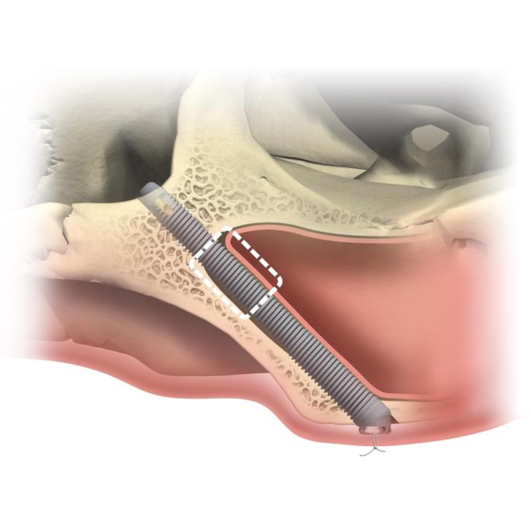 Zygomatic Implants in Kandivali