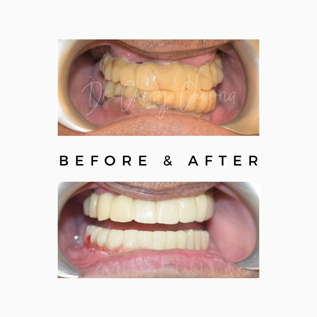 zygoma implant