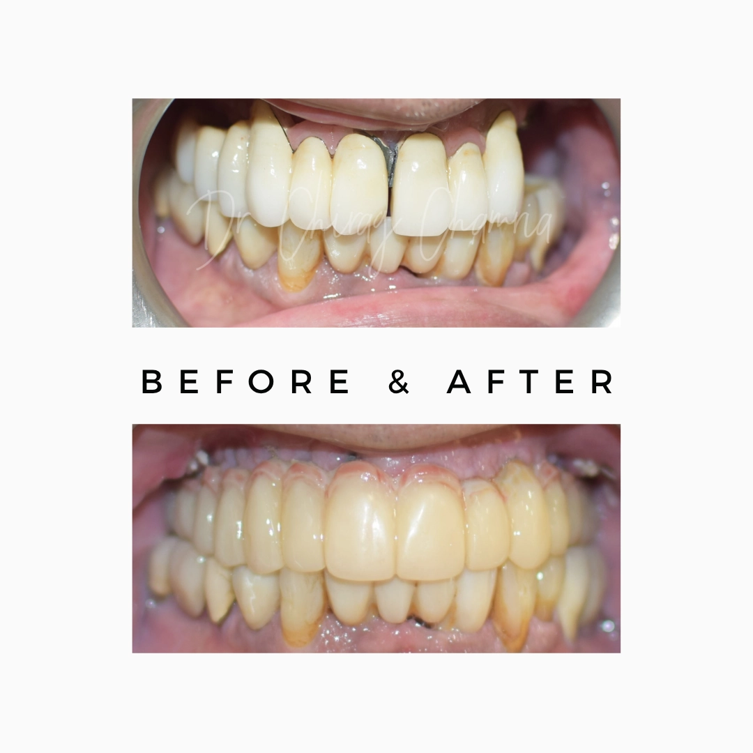 Zygomatic Implants for Selected Upper-Jaw Bone-Loss Cases