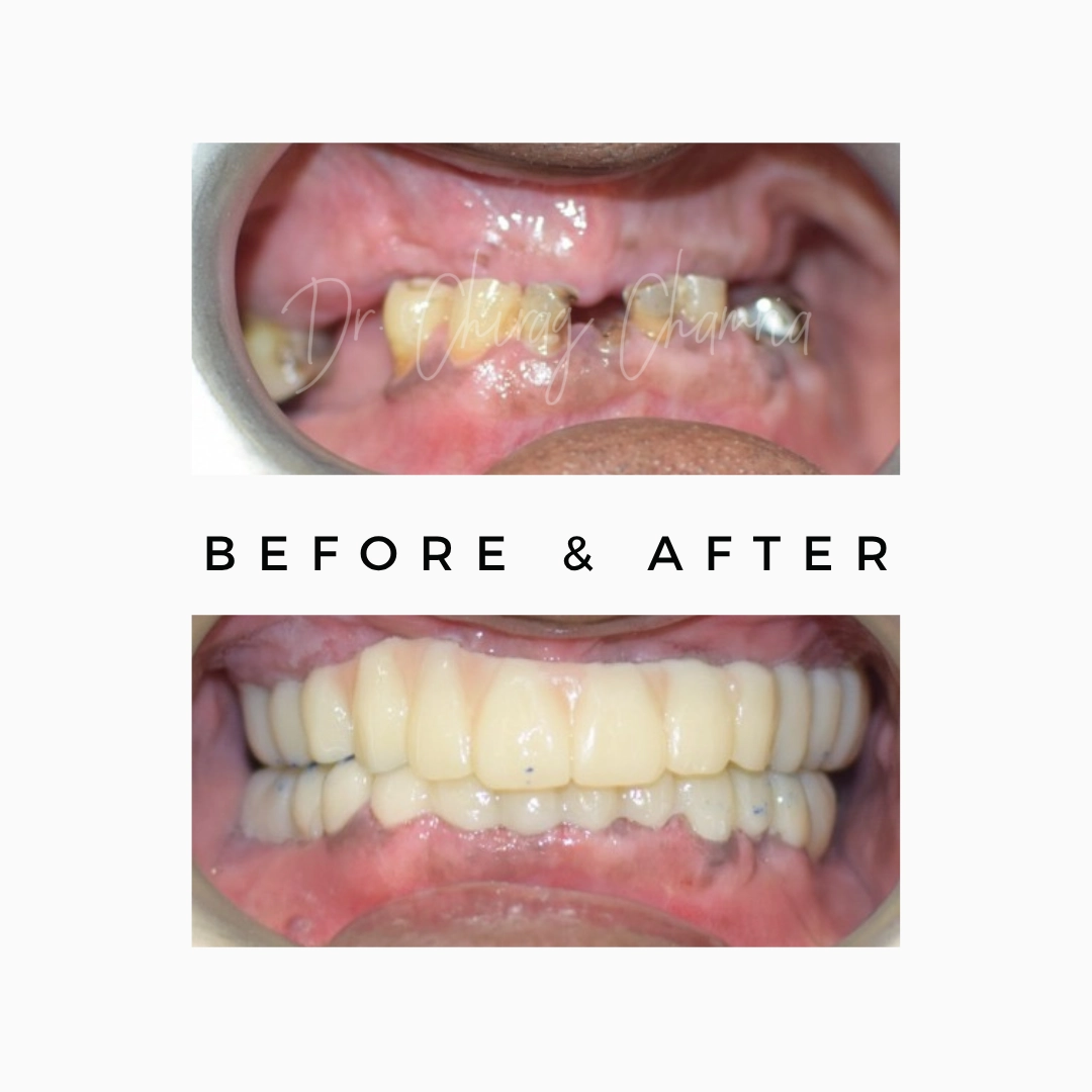 Zygomatic Implants for Selected Upper-Jaw Bone-Loss Cases