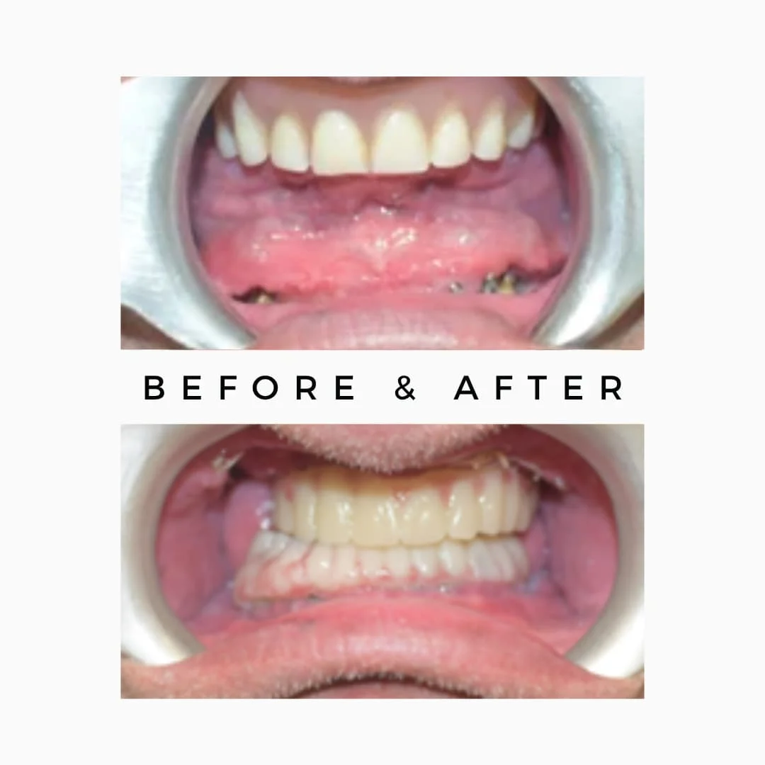 Zygomatic Dental Implant with Fixed Teeth