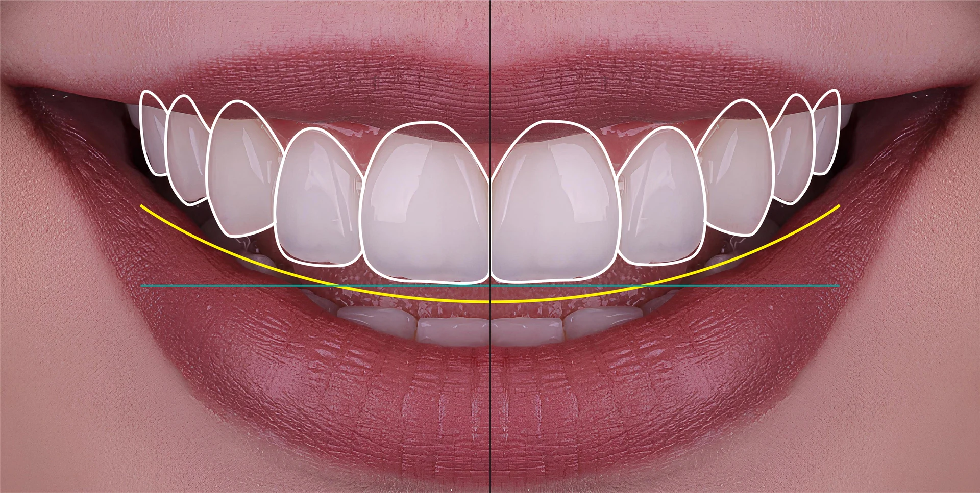 Smile Design | Cosmetic Dentistry