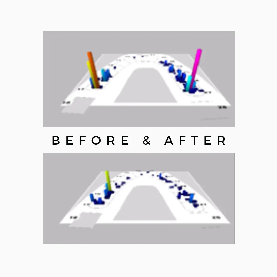 Full Mouth Bite Correction Before After