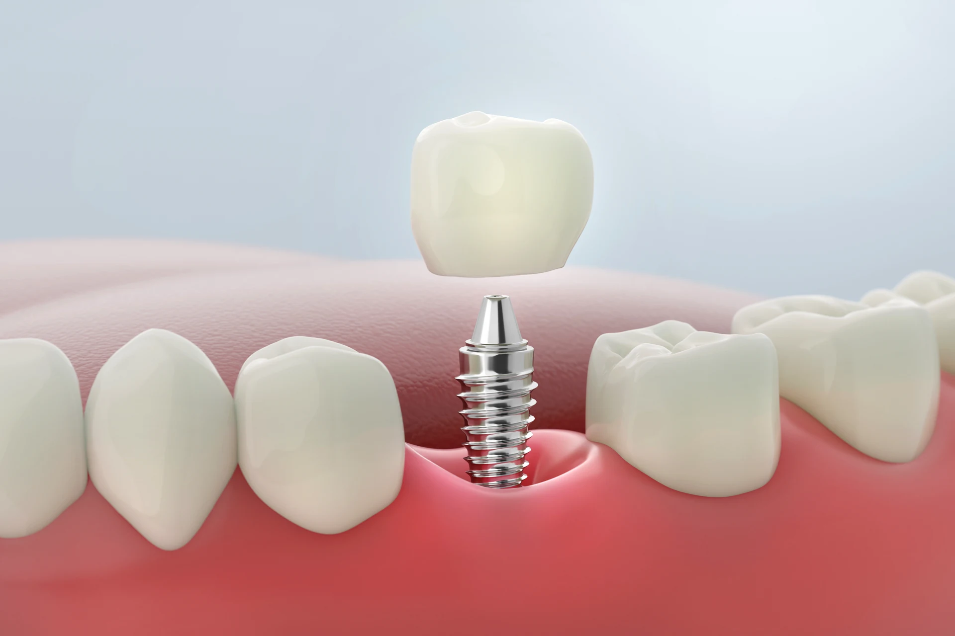 Same day dental implants