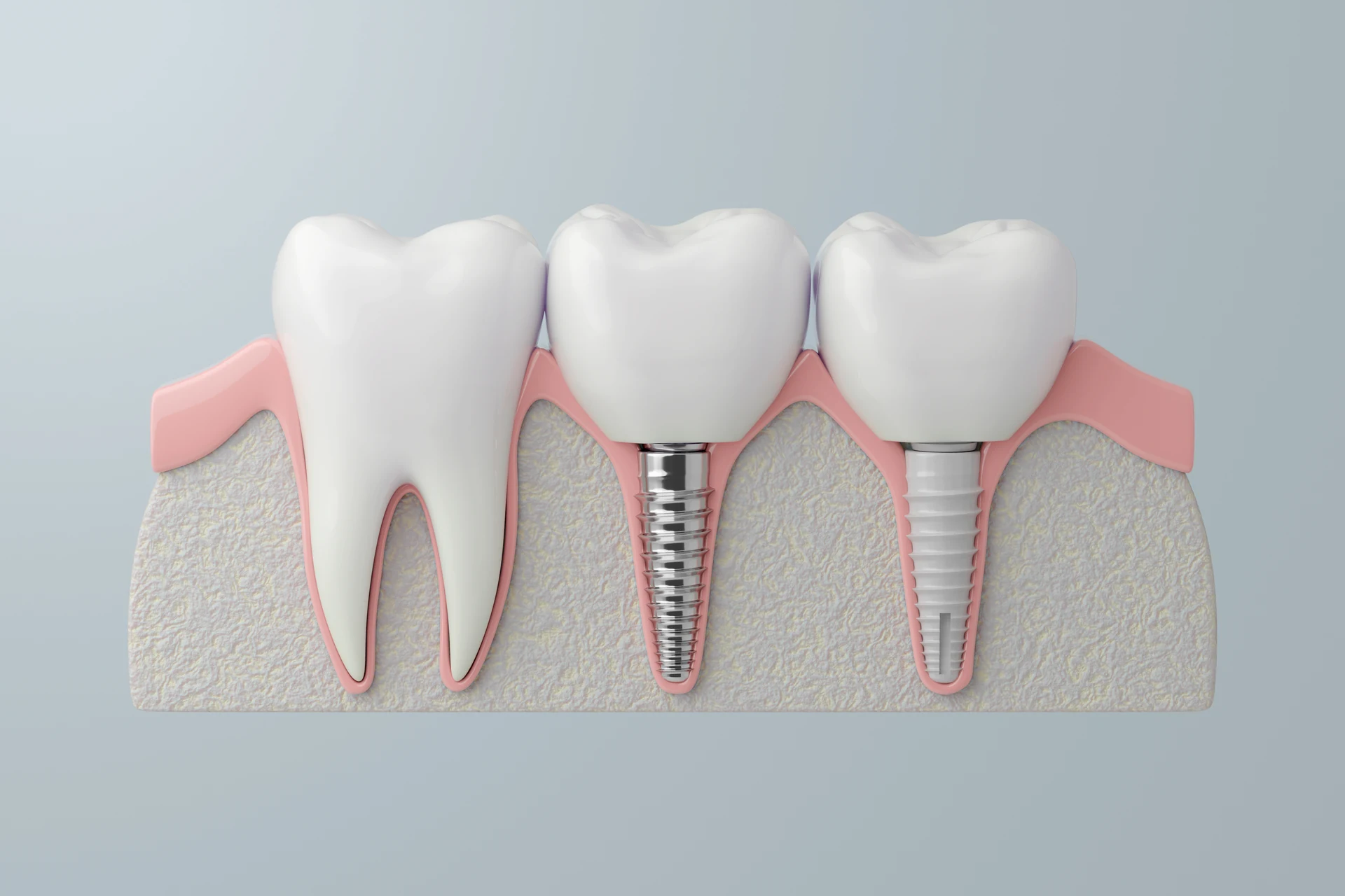 Same day dental implants in Mumbai
