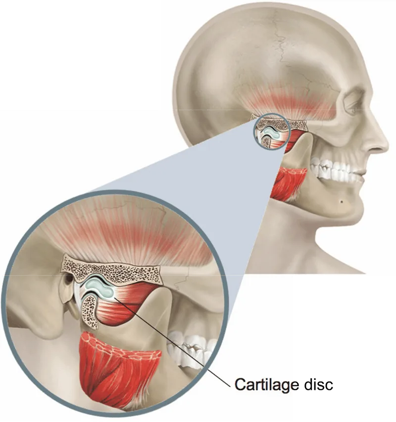 TMJ Treatment Without Surgery: Physiotherapy, Exercises, Splints, Habits and Self-Care
